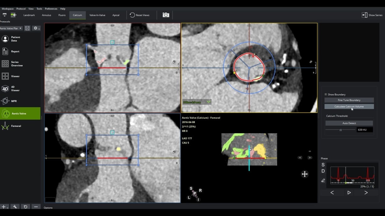 Aortic valve