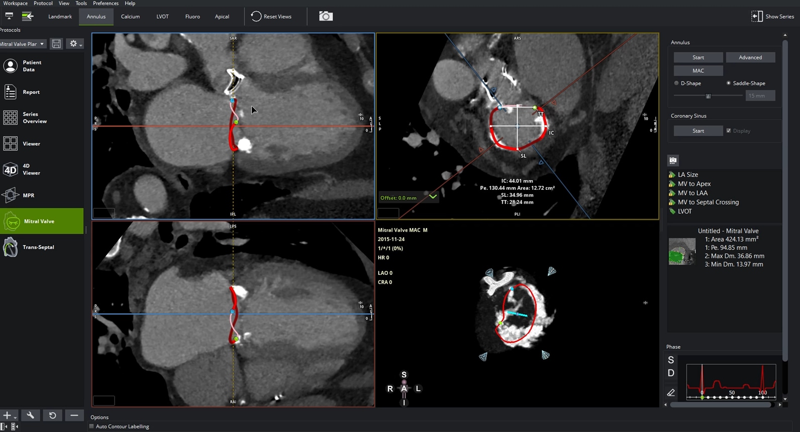 Mitral Valve
