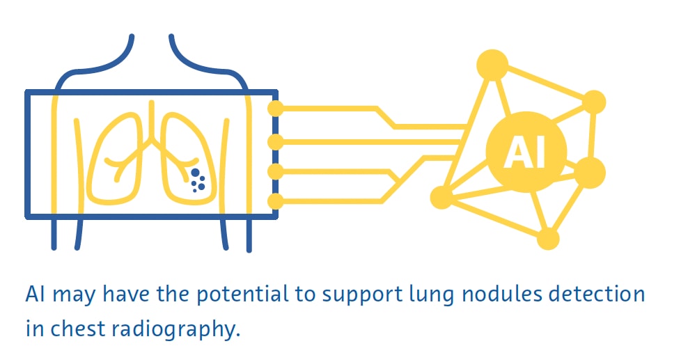 Lung nodule detection