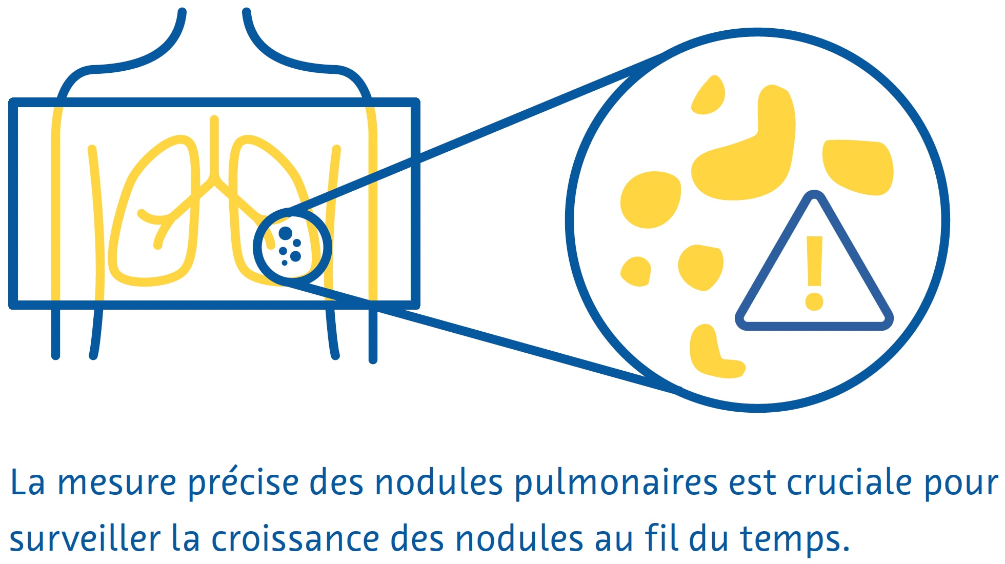 des-nodules